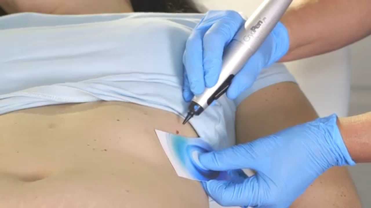 cryo how it works