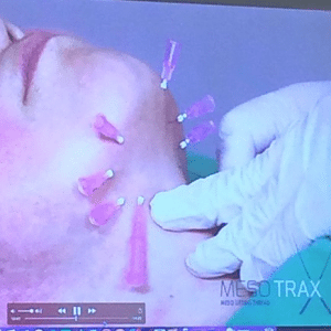 Meso Trax face lift
