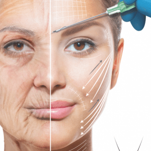 Meso Trax face lift UK London Meso Trax PDO Threadlift In London