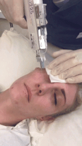 mesotherapy hyaluronic acid skin rejuvenation London
