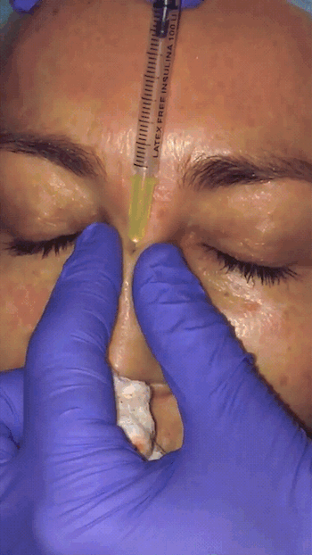 non-surgical rhinoplasty london
