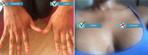 nithya collagen injections before after