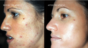 the perfect peel uk london