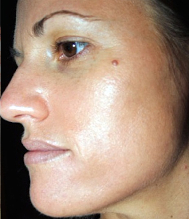 TPT After Peel – bea Skin Clinic