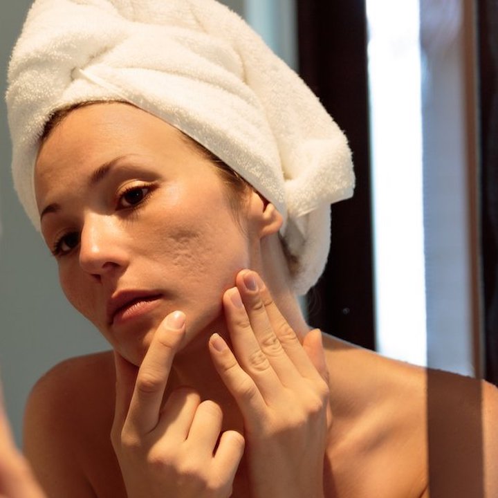 Acne Scar Removal treatment – bea Skin Clinic