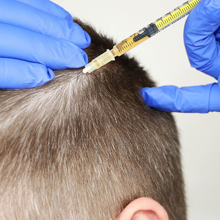 PRP Hair Loss – bea Skin Clinic